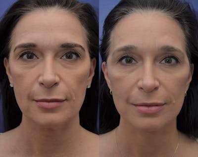 Full Facial Rejuvenation Before & After Gallery - Patient 917784 - Image 1