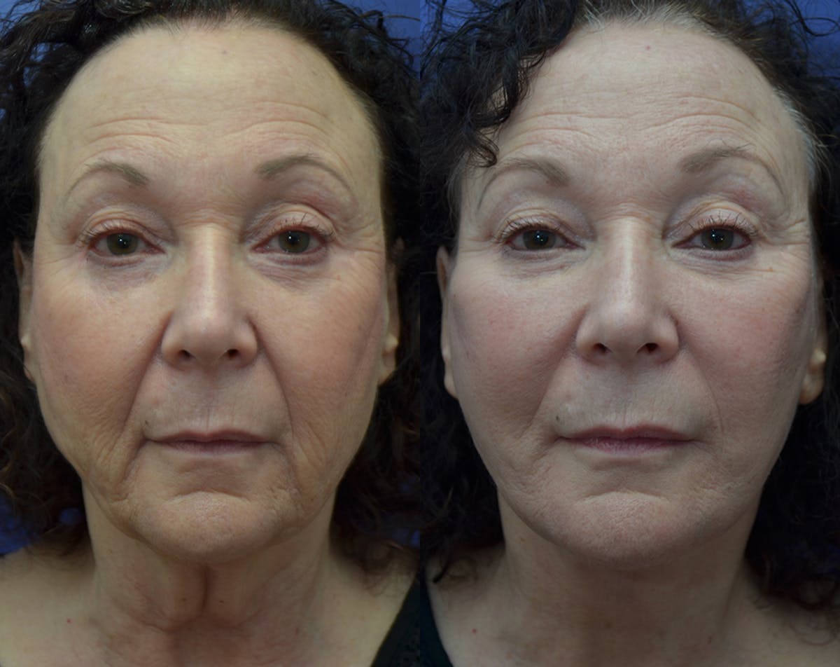 Deep Plane Facelift Before & After Gallery - Patient 165175 - Image 1