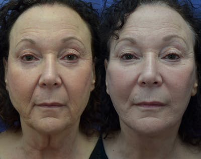 Full Facial Rejuvenation Before & After Gallery - Patient 388548 - Image 1