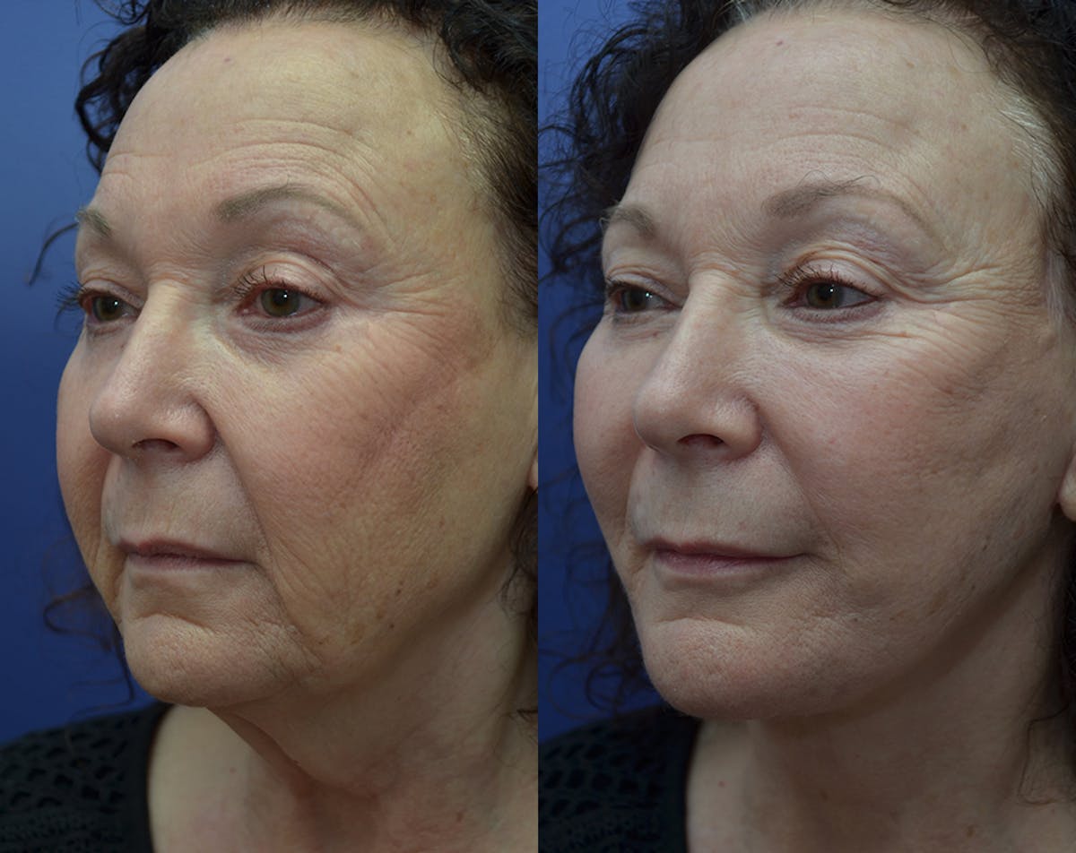 Deep Plane Facelift Before & After Gallery - Patient 165175 - Image 2
