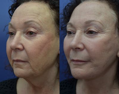 Full Facial Rejuvenation Before & After Gallery - Patient 388548 - Image 2