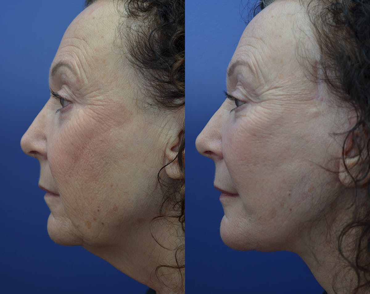 Deep Plane Facelift Before & After Gallery - Patient 165175 - Image 3