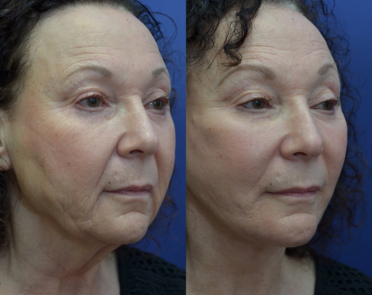 Deep Plane Facelift Before & After Gallery - Patient 165175 - Image 4