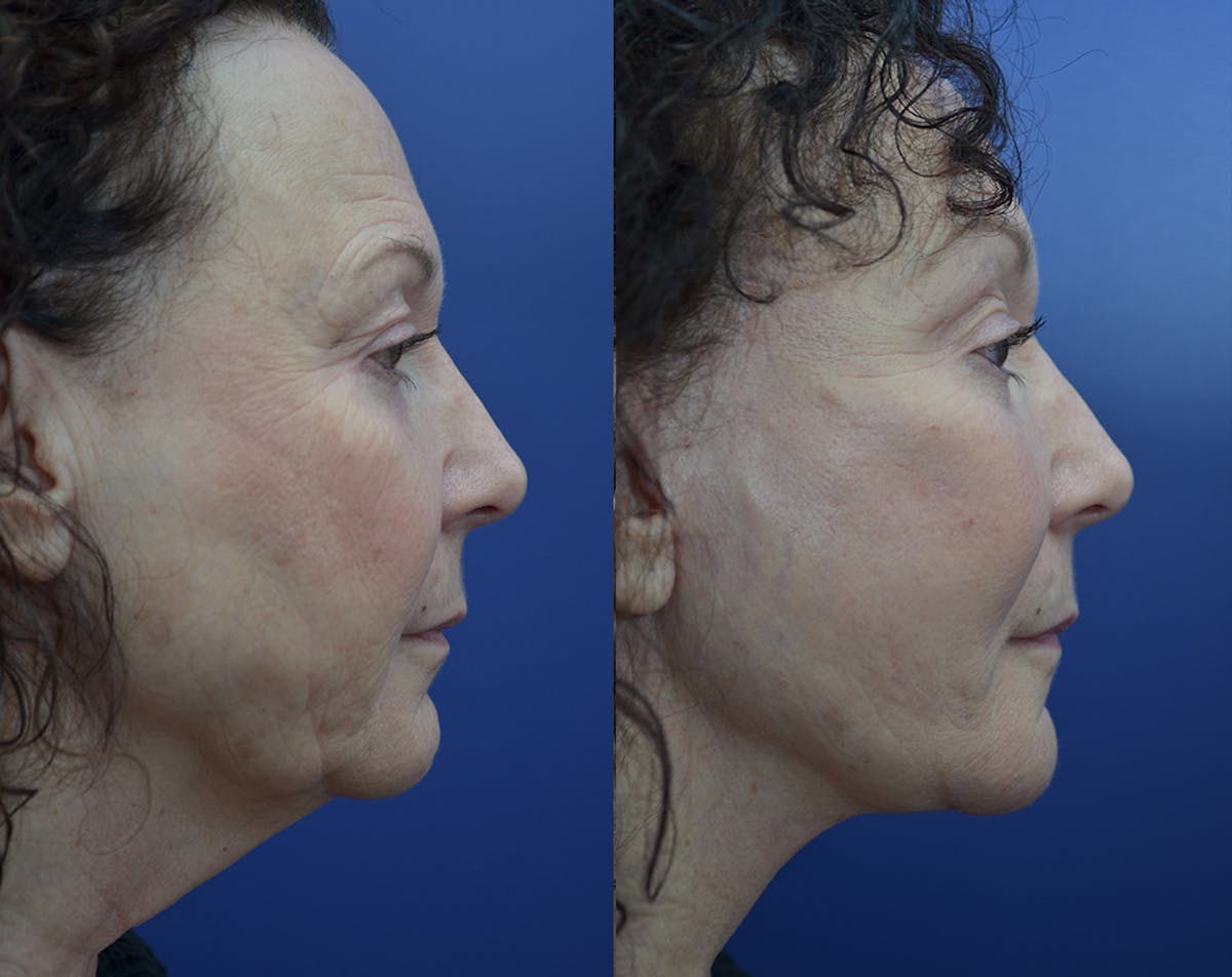 Deep Plane Facelift Before & After Gallery - Patient 165175 - Image 5