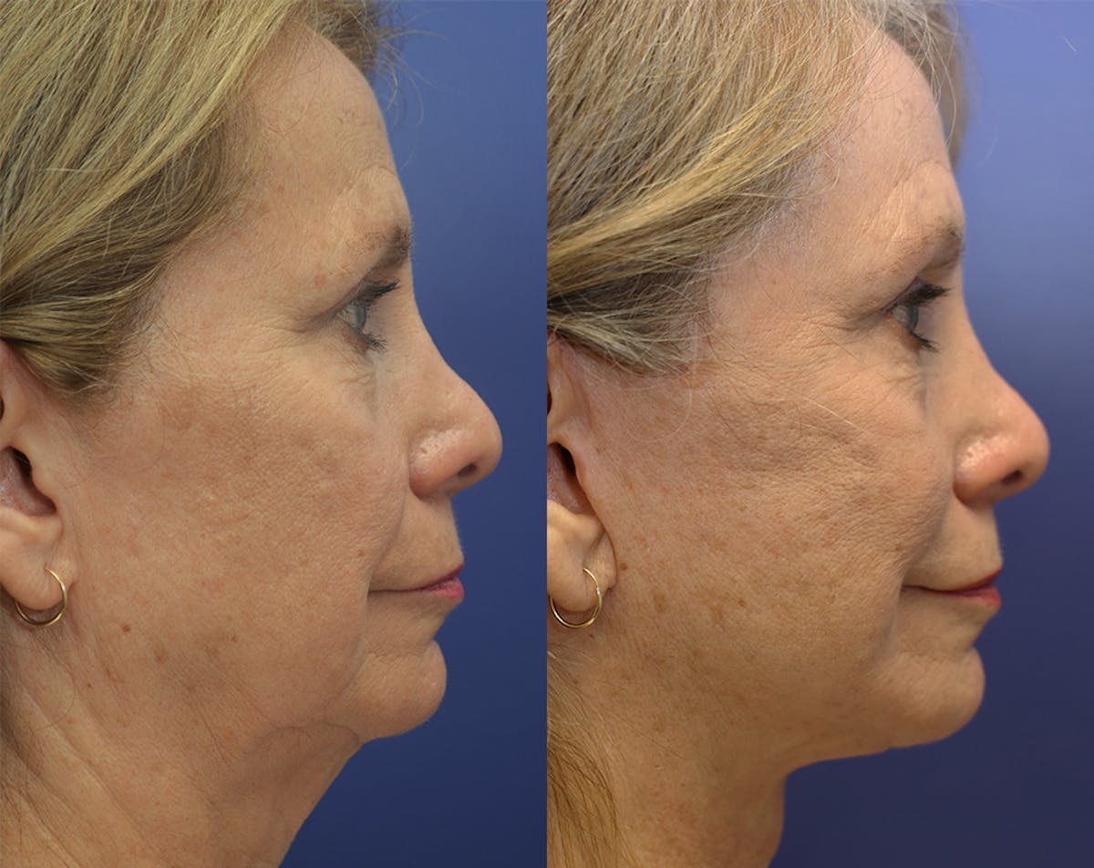 Deep Plane Facelift Before & After Gallery - Patient 110261 - Image 2
