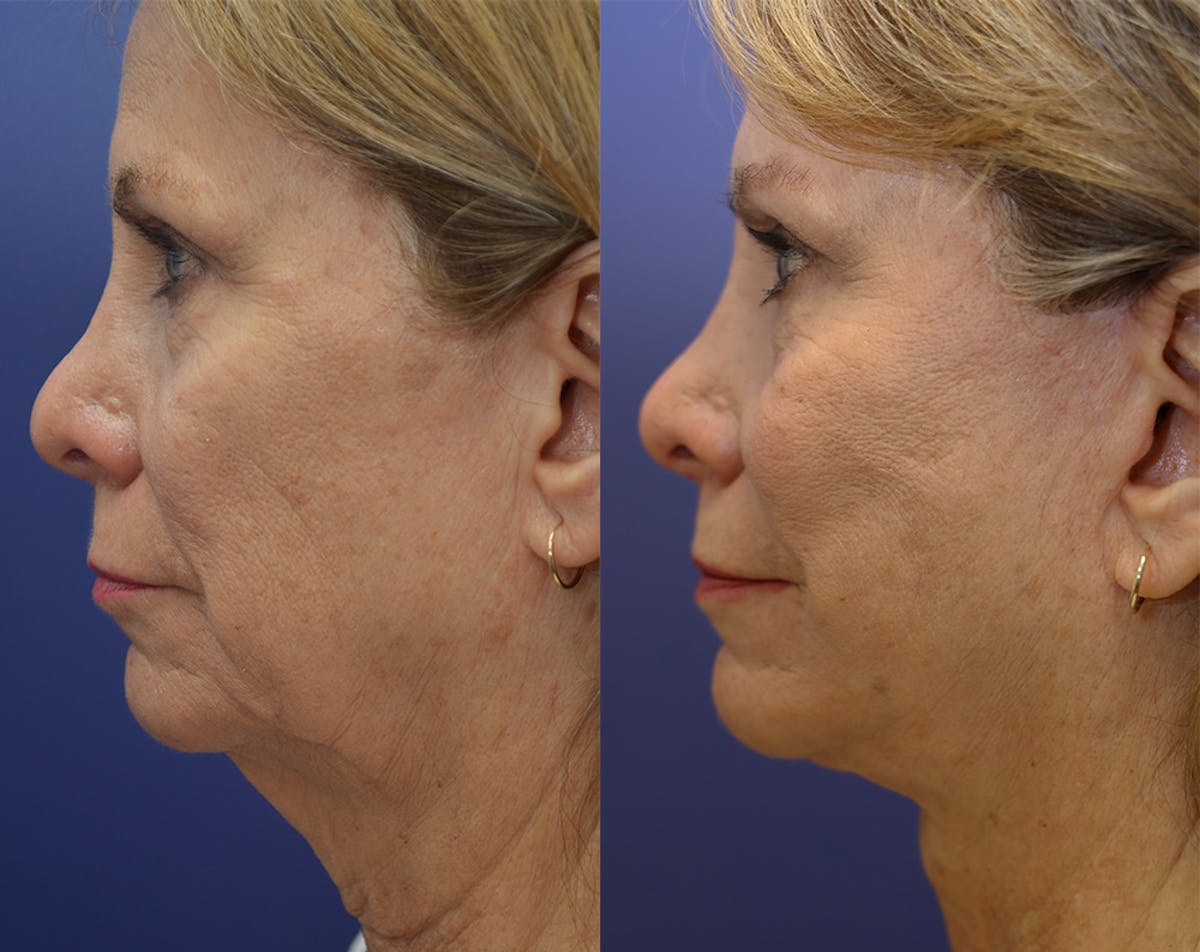 Deep Plane Facelift Before & After Gallery - Patient 110261 - Image 3