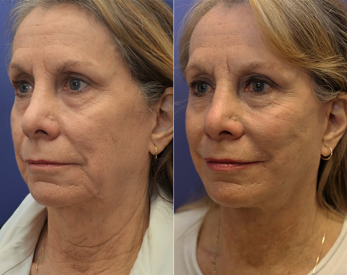 Deep Plane Facelift Before & After Gallery - Patient 110261 - Image 4