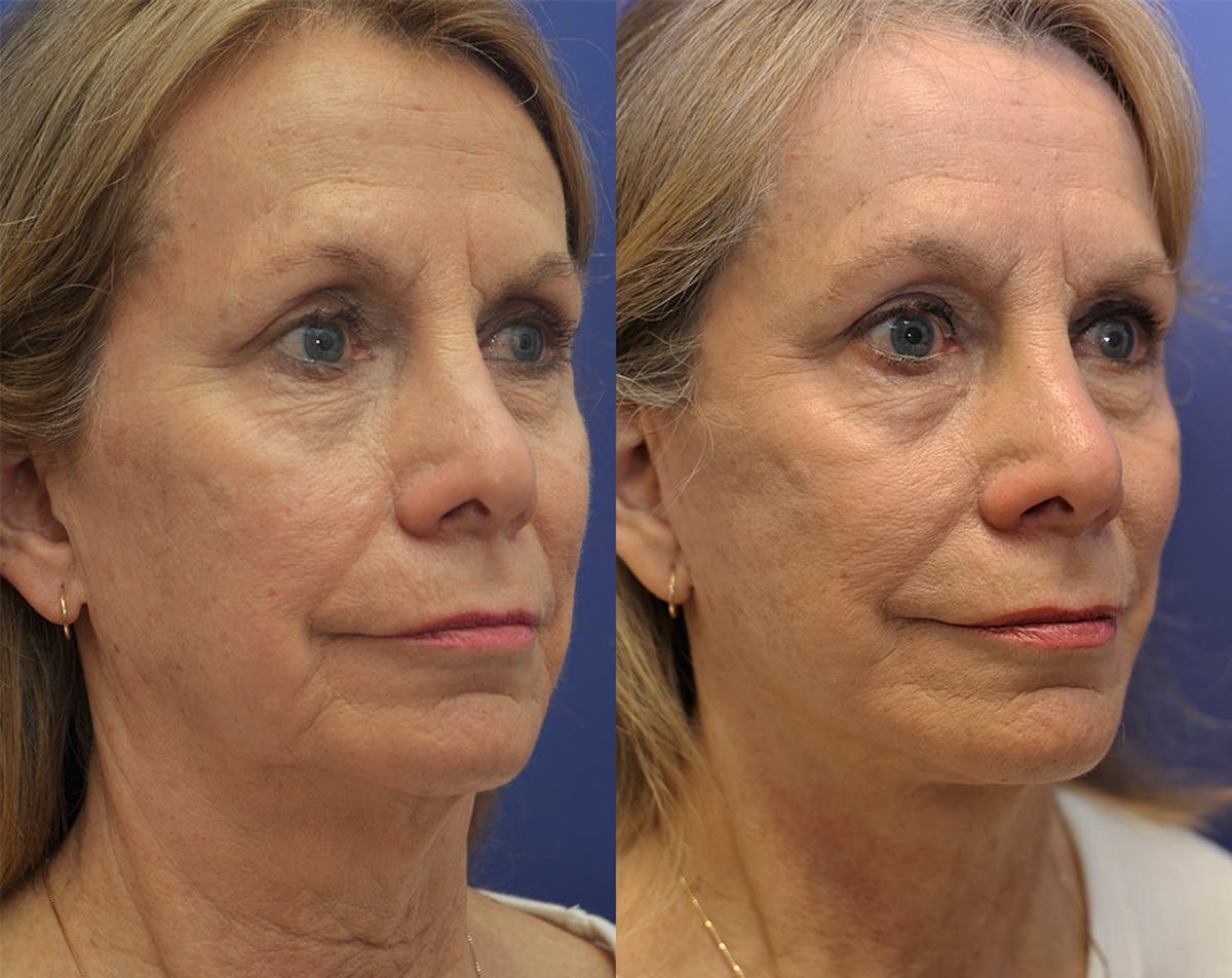 Deep Plane Facelift Before & After Gallery - Patient 110261 - Image 5
