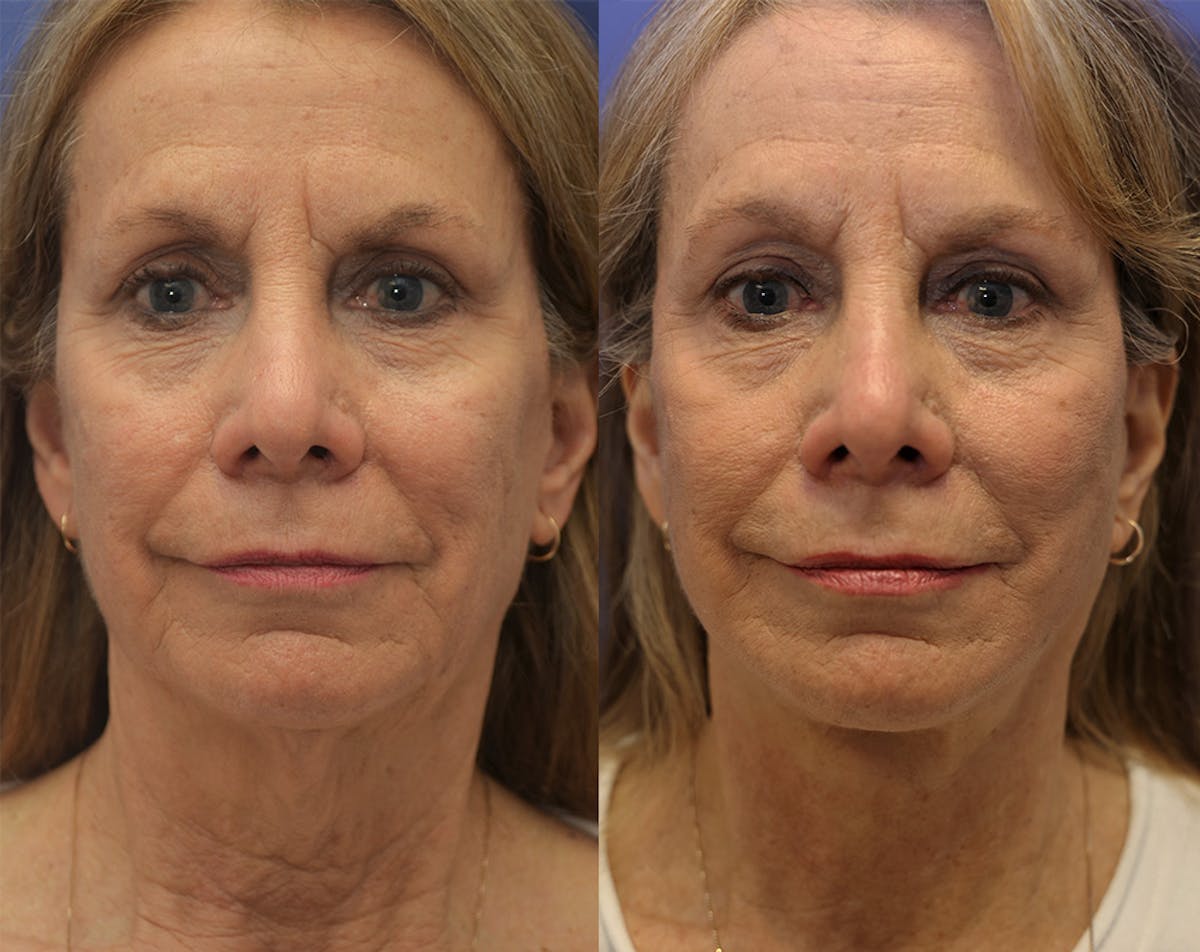 Deep Plane Facelift Before & After Gallery - Patient 110261 - Image 1