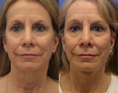 Full Facial Rejuvenation Before & After Gallery - Patient 395239 - Image 1