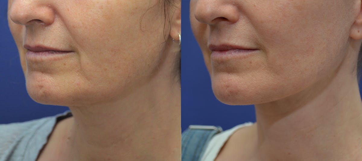 Deep Plane Facelift Before & After Gallery - Patient 814186 - Image 1