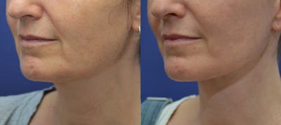 Full Facial Rejuvenation Before & After Gallery - Patient 398704 - Image 1