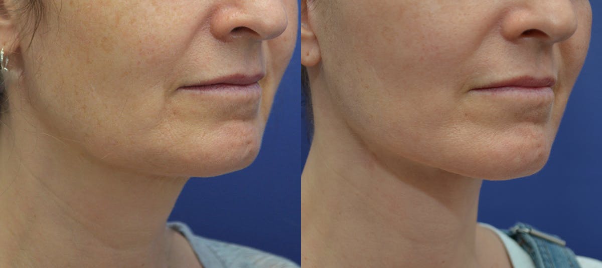 Deep Plane Facelift Before & After Gallery - Patient 814186 - Image 2
