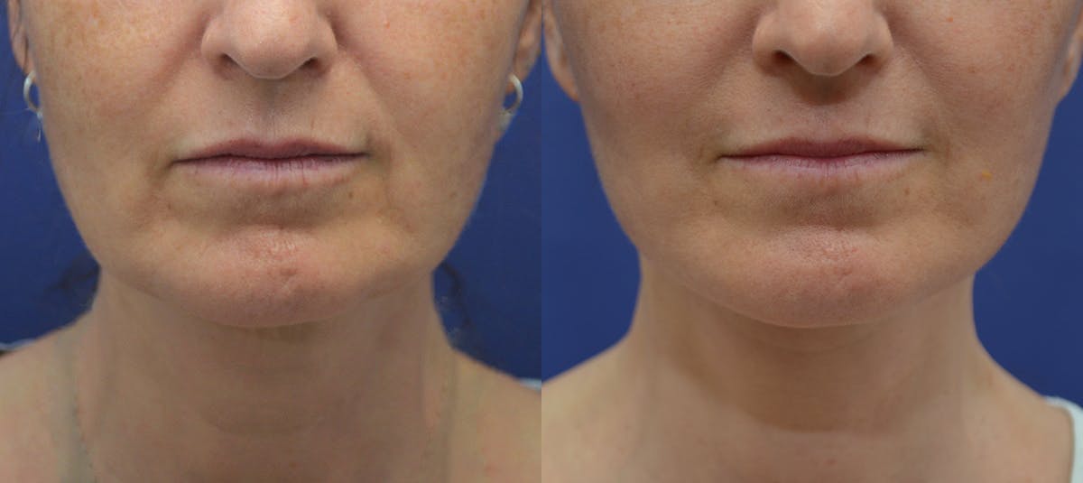 Deep Plane Facelift Before & After Gallery - Patient 814186 - Image 3
