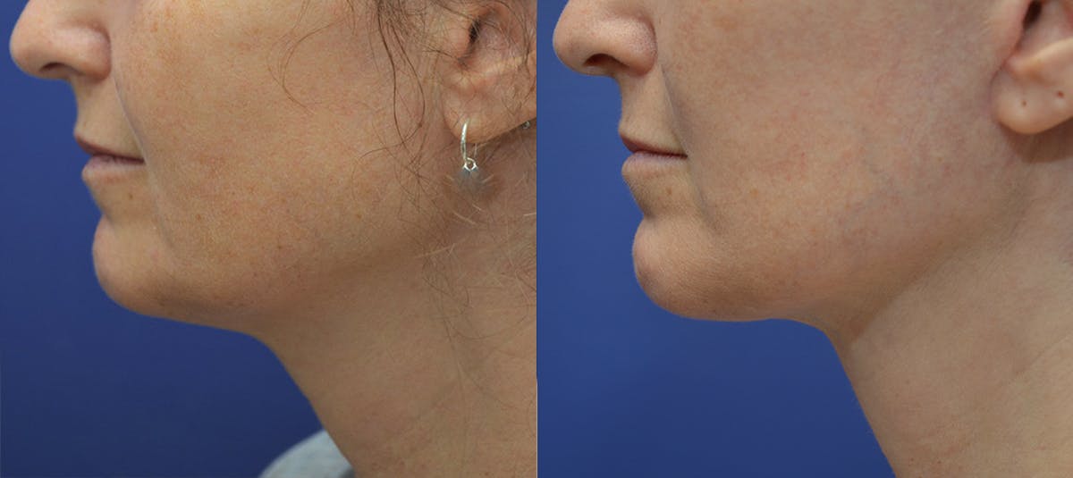 Deep Plane Facelift Before & After Gallery - Patient 814186 - Image 4