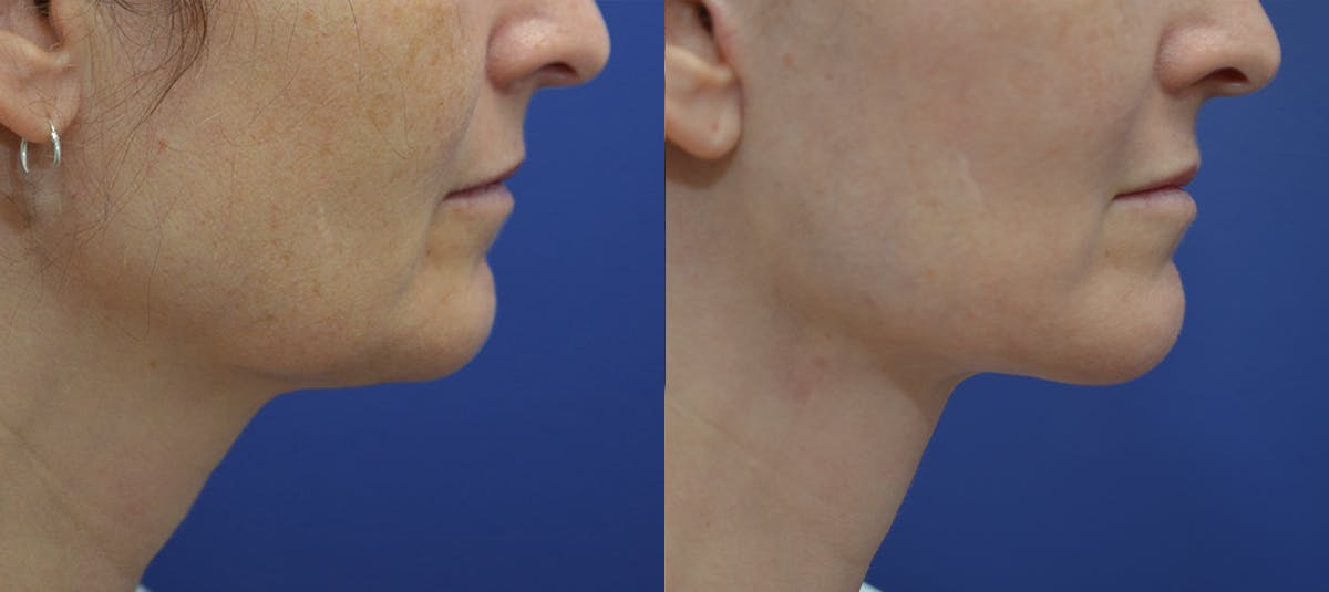 Deep Plane Facelift Before & After Gallery - Patient 814186 - Image 5