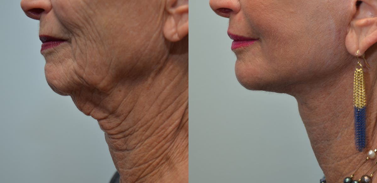 Deep Plane Neck Lift Before & After Gallery - Patient 293860 - Image 1