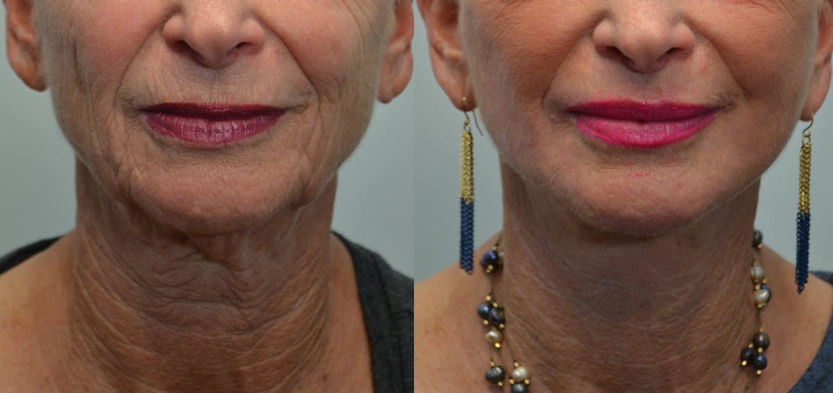 Deep Plane Neck Lift Before & After Gallery - Patient 293860 - Image 2