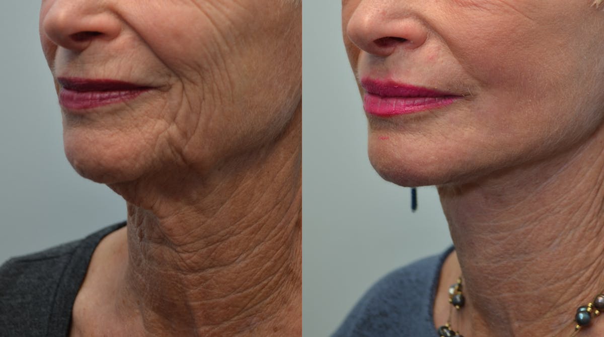 Deep Plane Neck Lift Before & After Gallery - Patient 293860 - Image 3