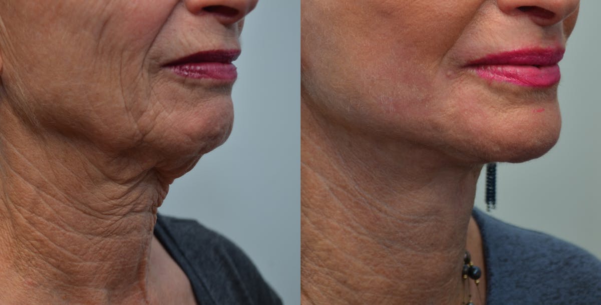 Deep Plane Neck Lift Before & After Gallery - Patient 293860 - Image 4