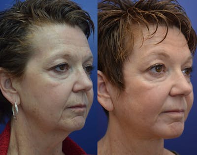 Full Facial Rejuvenation Before & After Gallery - Patient 409093 - Image 2