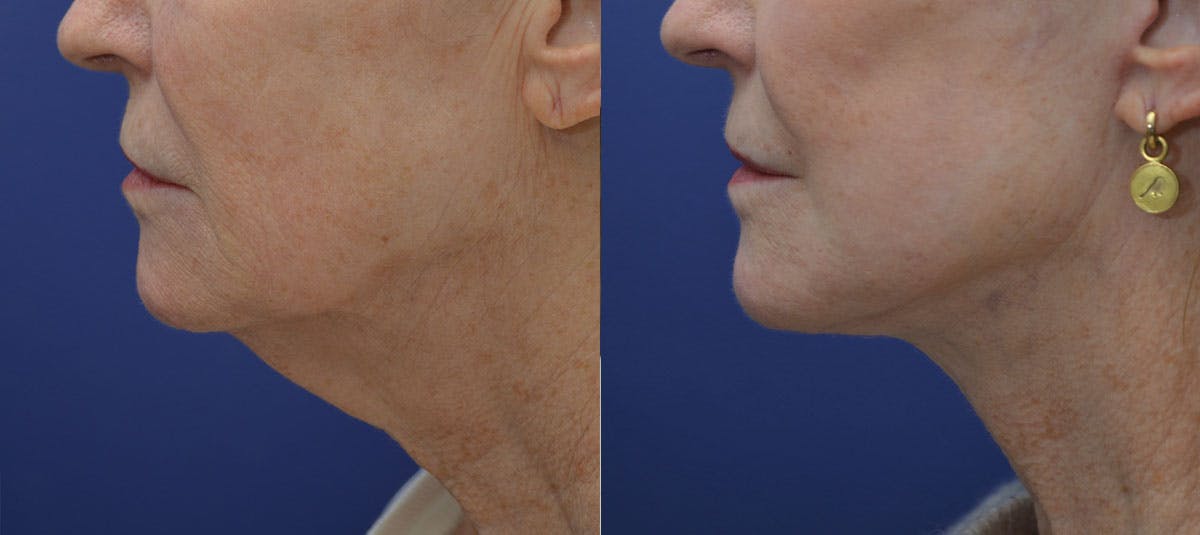 Deep Plane Facelift Before & After Gallery - Patient 132662 - Image 2