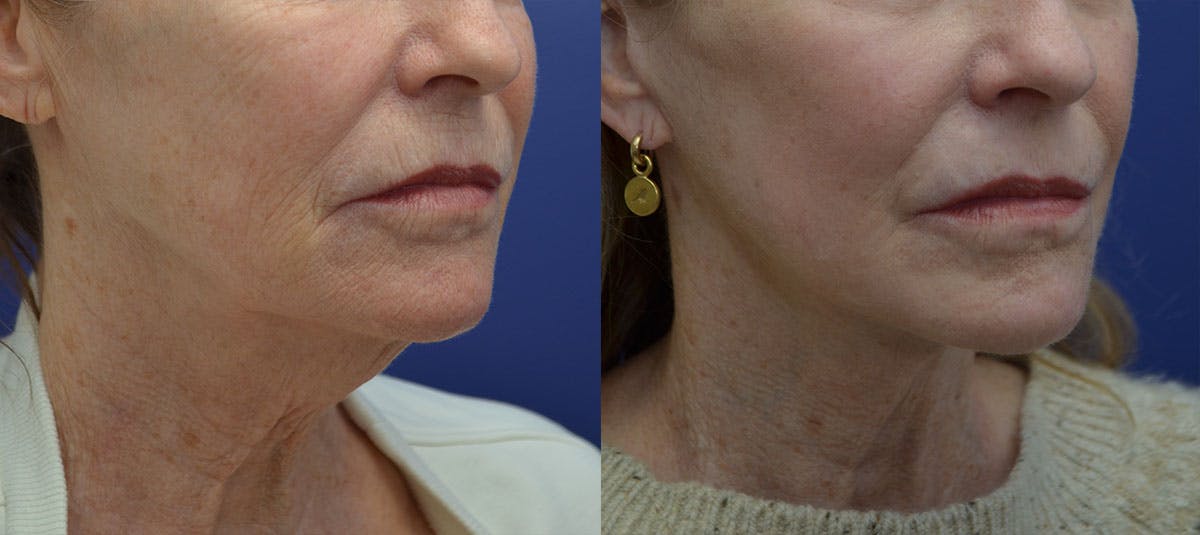 Deep Plane Facelift Before & After Gallery - Patient 132662 - Image 4