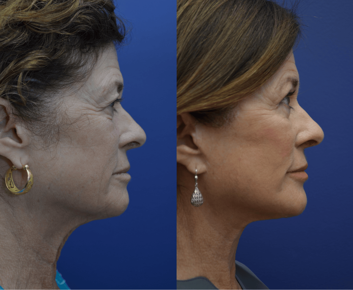 Deep Plane Facelift Before & After Gallery - Patient 237526 - Image 2