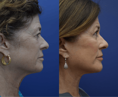 Full Facial Rejuvenation Before & After Gallery - Patient 230271 - Image 2
