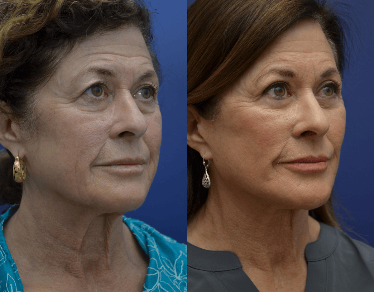 Deep Plane Facelift Before & After Gallery - Patient 237526 - Image 3