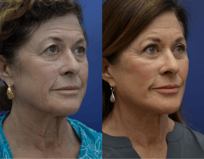 Full Facial Rejuvenation Before & After Gallery - Patient 186352 - Image 1