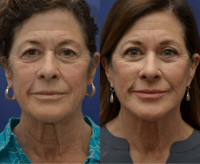 Full Facial Rejuvenation Before & After Gallery - Patient 230271 - Image 1