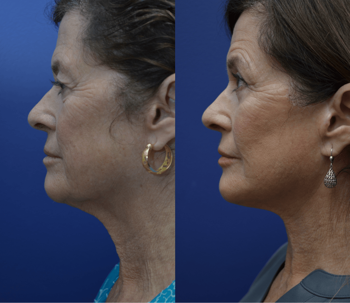 Deep Plane Facelift Before & After Gallery - Patient 237526 - Image 4