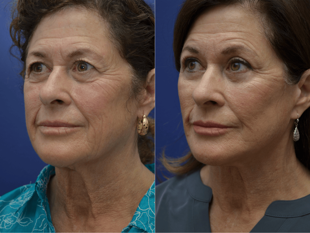 Deep Plane Facelift Before & After Gallery - Patient 237526 - Image 5