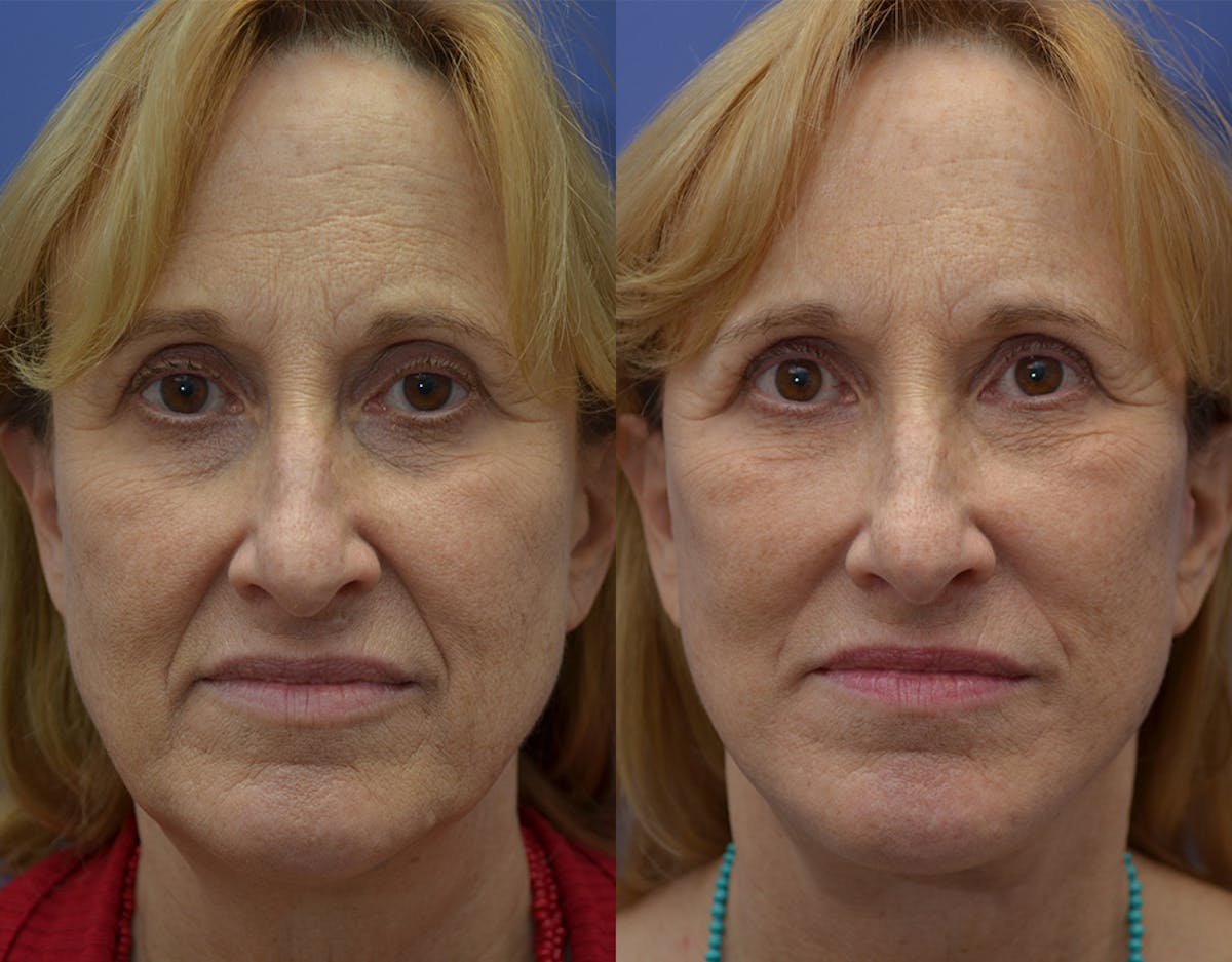 Deep Plane Facelift Before & After Gallery - Patient 178975 - Image 1