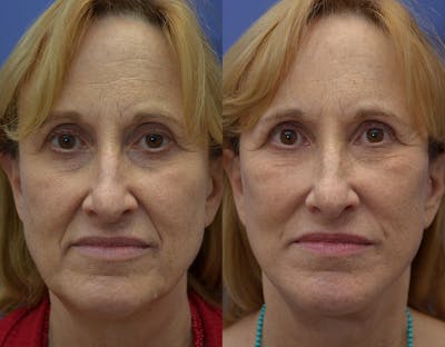 Full Facial Rejuvenation Before & After Gallery - Patient 106177 - Image 1