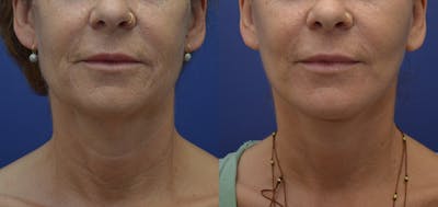 Full Facial Rejuvenation Before & After Gallery - Patient 241166 - Image 2