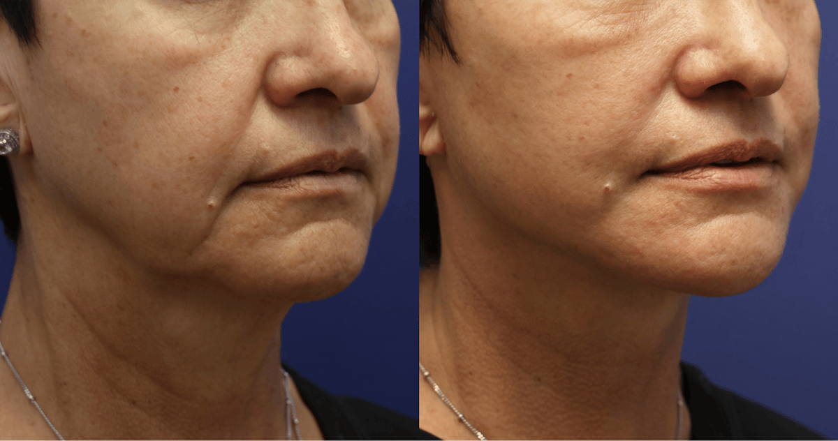 Deep Plane Facelift Before & After Gallery - Patient 228896 - Image 1