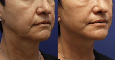 Full Facial Rejuvenation Before & After Gallery - Patient 474479 - Image 1