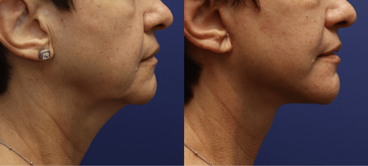 Deep Plane Facelift Before & After Gallery - Patient 228896 - Image 2