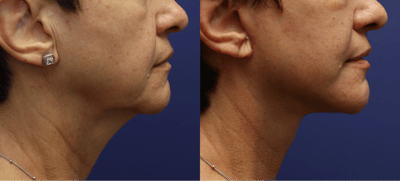 Full Facial Rejuvenation Before & After Gallery - Patient 474479 - Image 2