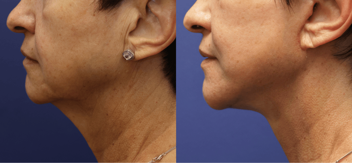 Deep Plane Facelift Before & After Gallery - Patient 228896 - Image 3