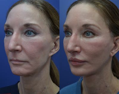 Full Facial Rejuvenation Before & After Gallery - Patient 145306 - Image 2