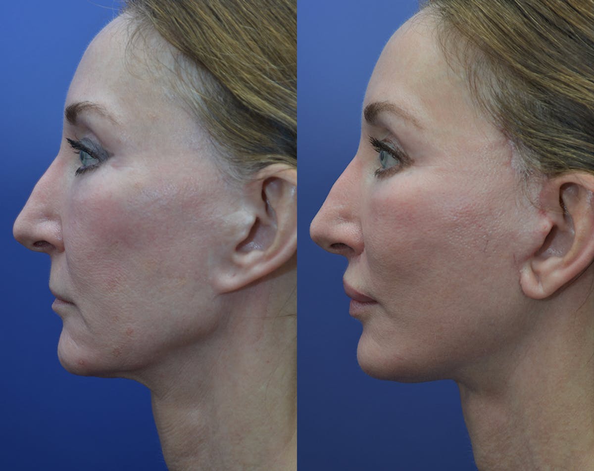 Full Facial Rejuvenation Before & After Gallery - Patient 145306 - Image 3