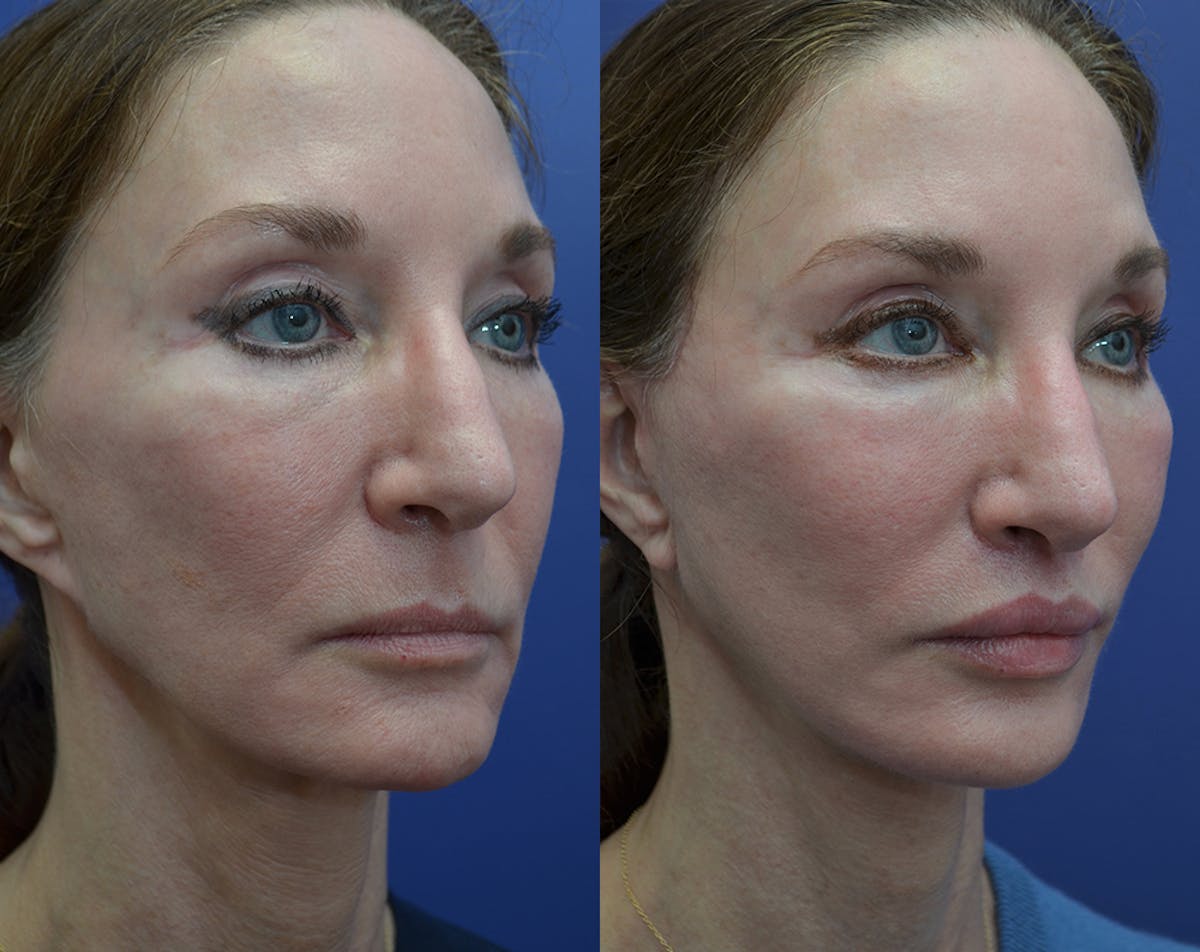 Full Facial Rejuvenation Before & After Gallery - Patient 145306 - Image 4