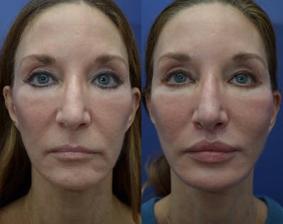 Full Facial Rejuvenation Before & After Gallery - Patient 145306 - Image 1