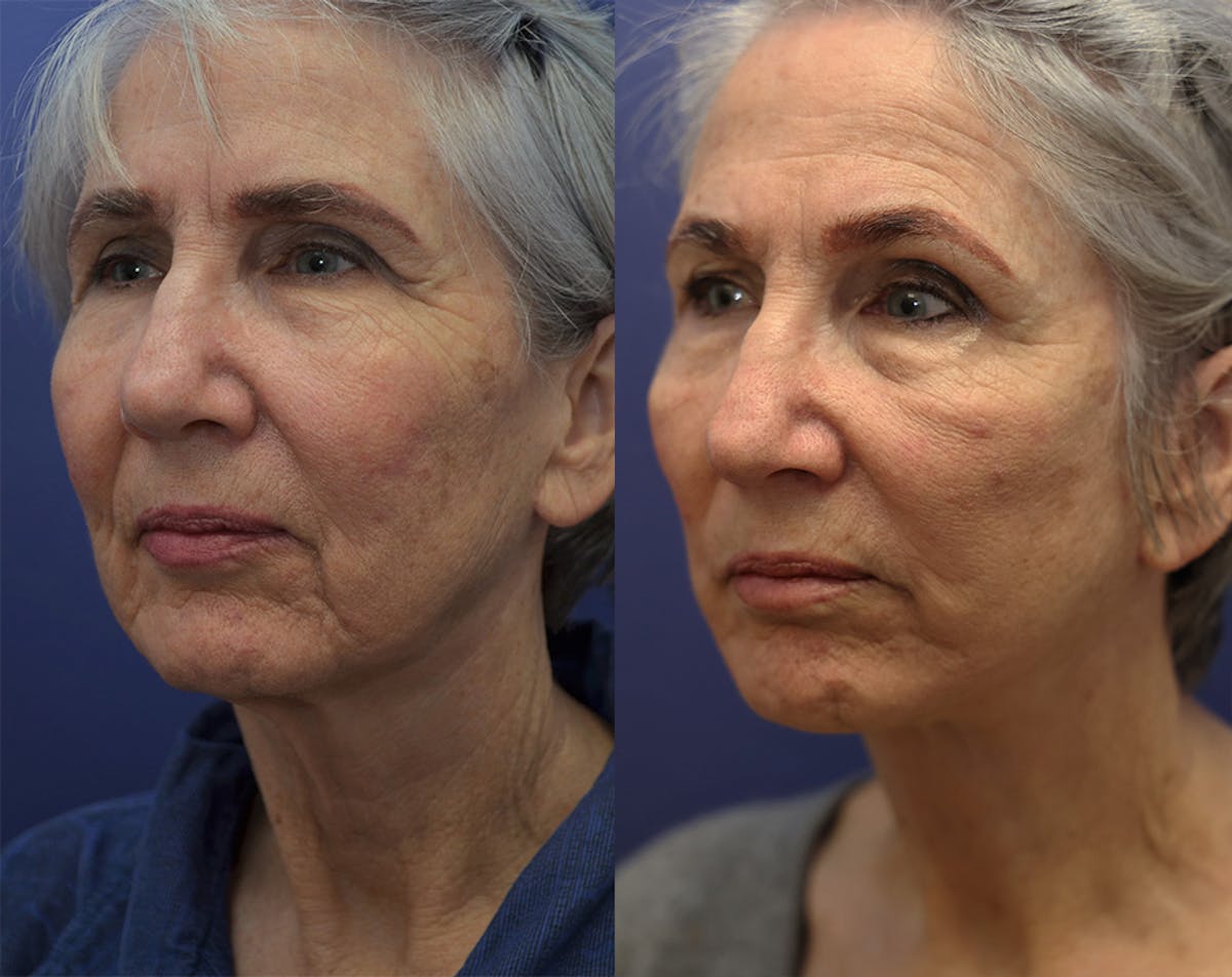 Deep Plane Facelift Before & After Gallery - Patient 348350 - Image 2