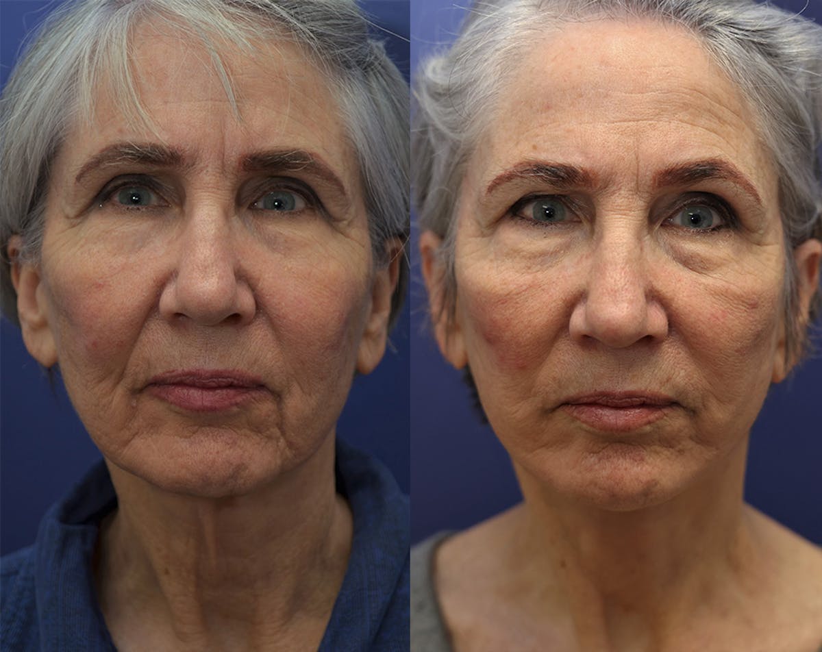 Deep Plane Facelift Before & After Gallery - Patient 348350 - Image 1