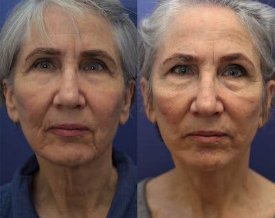 Full Facial Rejuvenation Before & After Gallery - Patient 339655 - Image 1