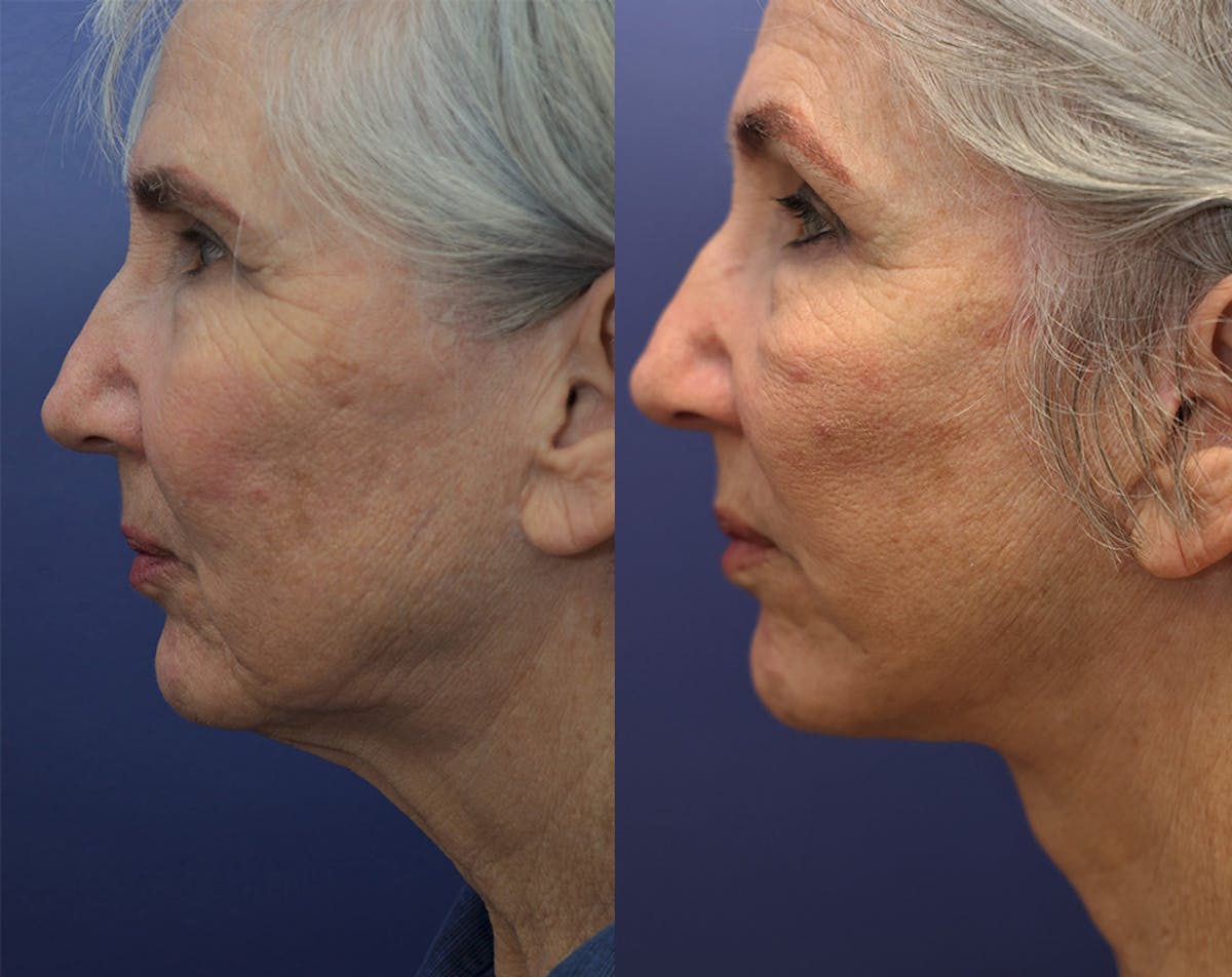 Deep Plane Facelift Before & After Gallery - Patient 348350 - Image 3